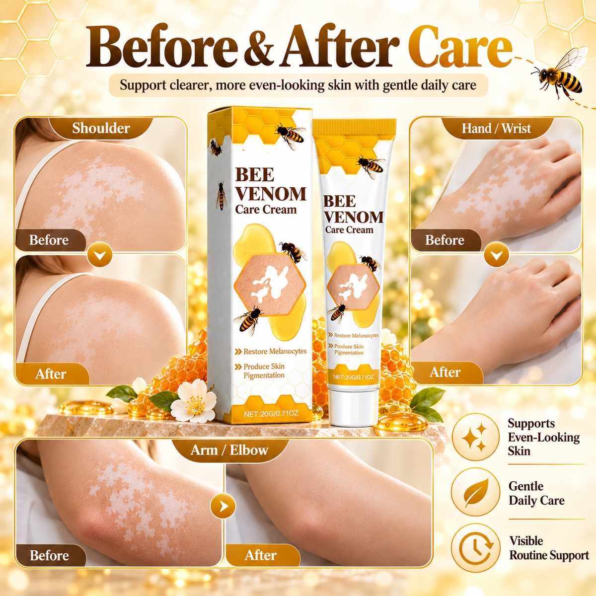 Vitiligo Treatment Cream | Bee Venom Vitiligo Treatment Ointment